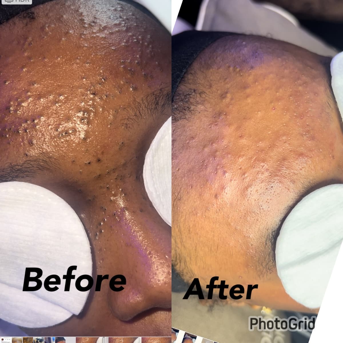 Acne Facials